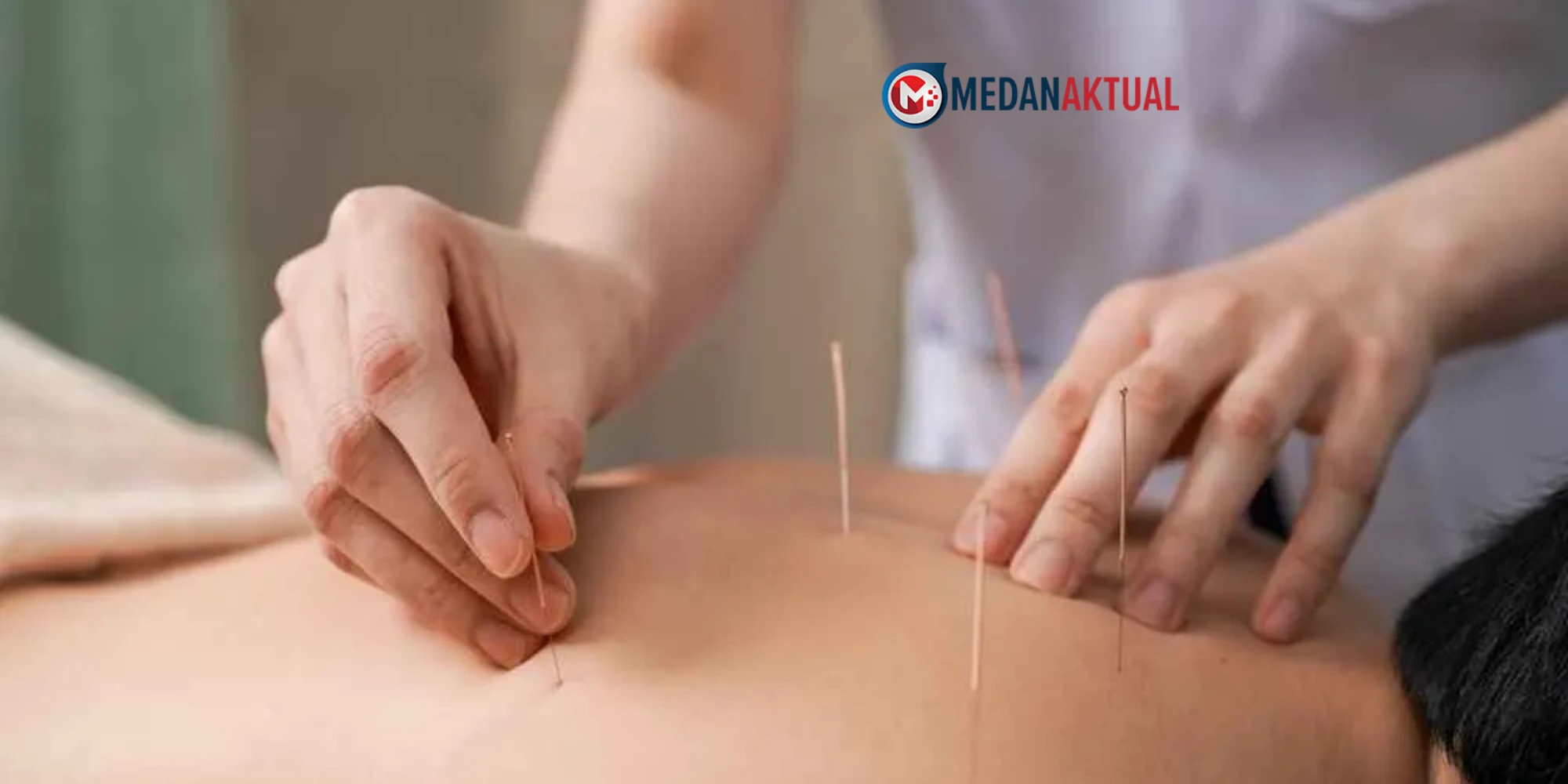 6 Rekomendasi Tempat Terapi Akupuntur di Medan dan Sekitarnya